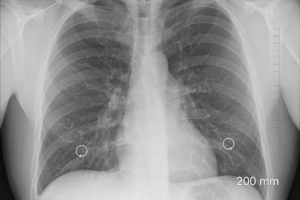 FN Plzeň se zaměří na nádory plic, v Česku je jich diagnostikováno 6000 ročně